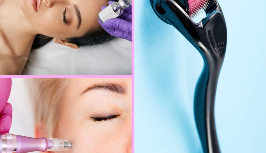 microneedling